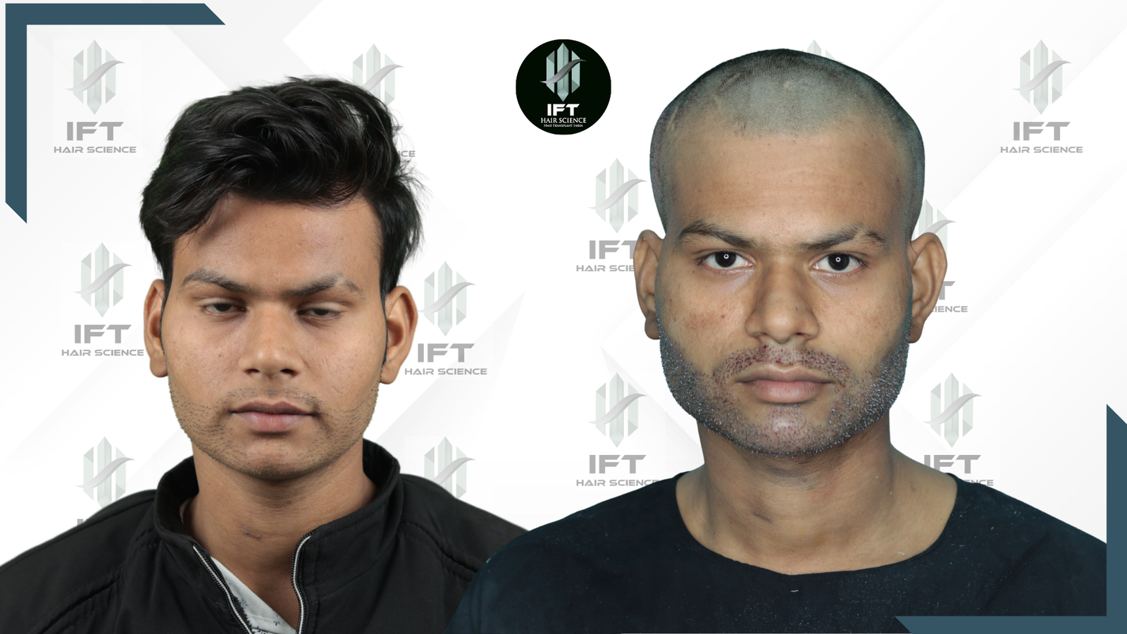 beard transplant in india - IFT clinic