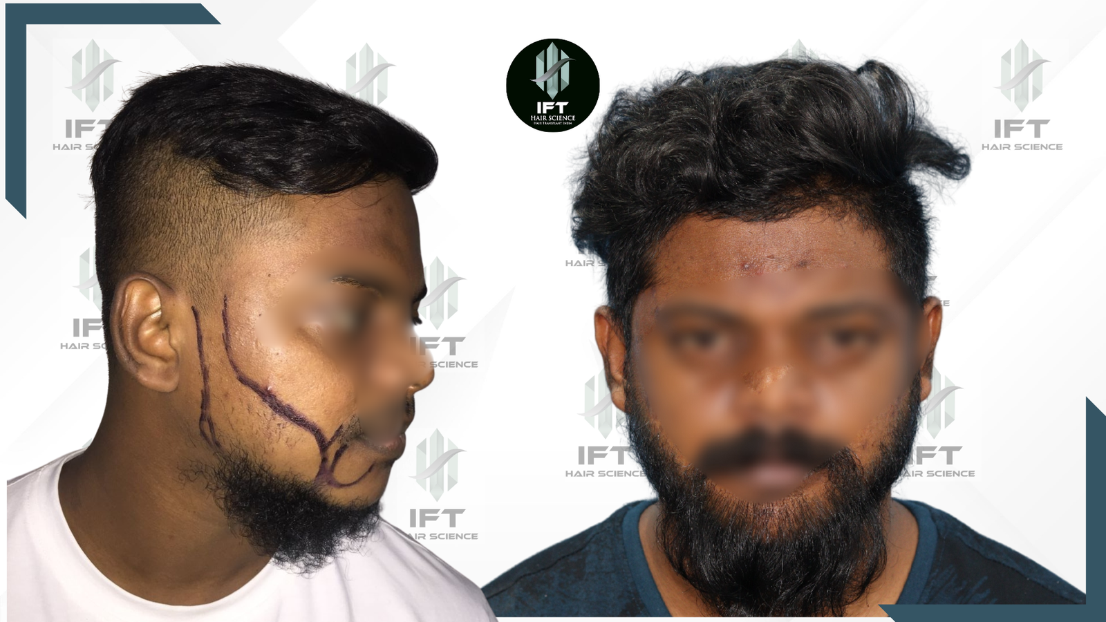 beard transplant in india - IFT clinic