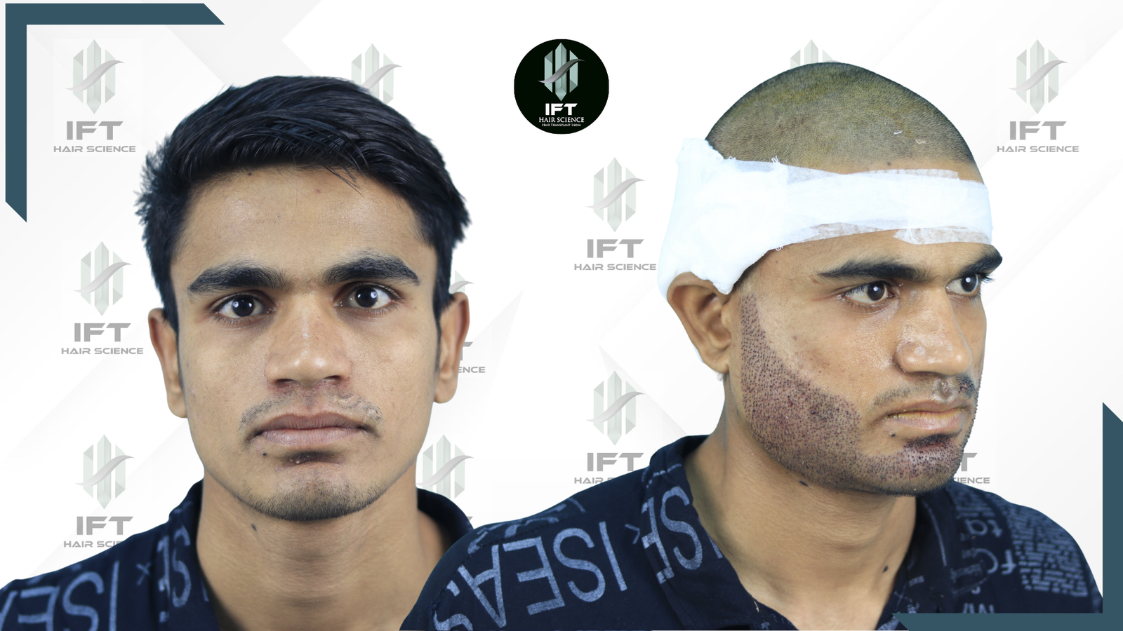 beard transplant in india - IFT clinic