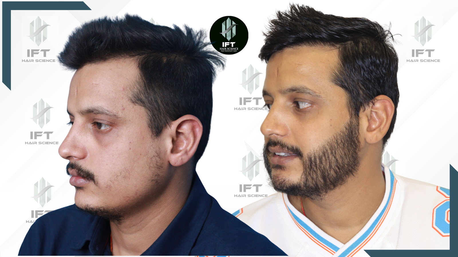 beard transplant in india - IFT clinic
