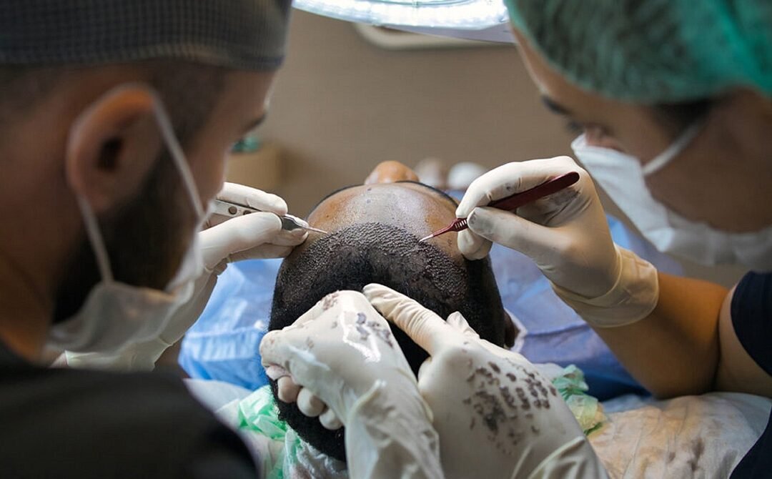 What is the Interlocking FUE Technique of Hair Transplant?