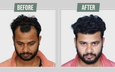 Understanding the Long-Term Benefits of Hair Transplants