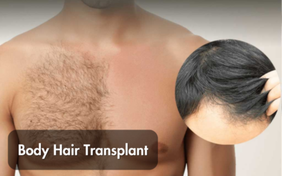 Natural-Looking Hair Transplants in Jaipur: Boost Confidence with IFT’s Body Hair Transplant Expertise and Personalized Care