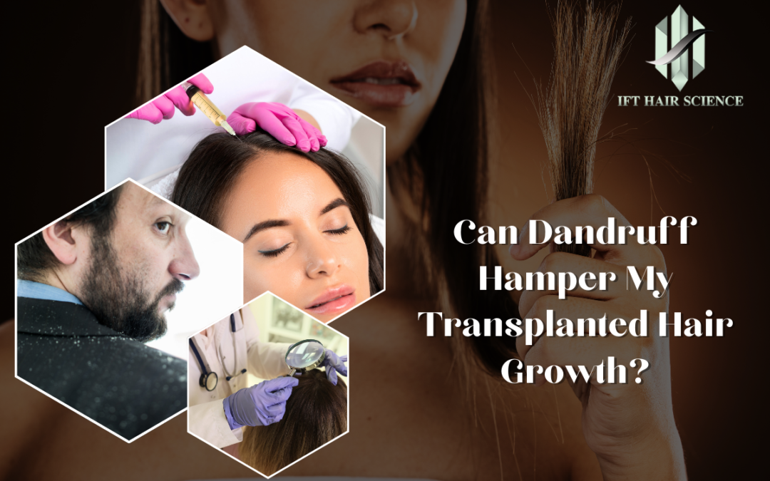 Can Dandruff Hamper My Transplanted Hair Growth