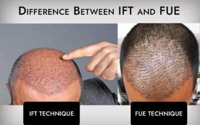 IFT और FUE के बीच अंतर