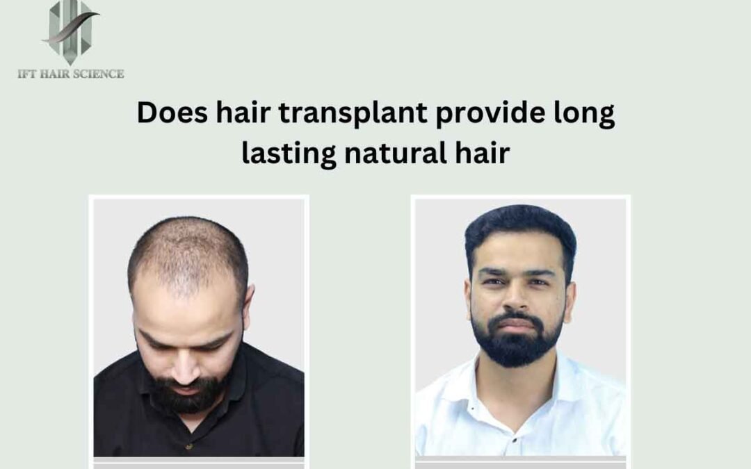 Does Hair Transplant Provide Long-Lasting Natural Hair?