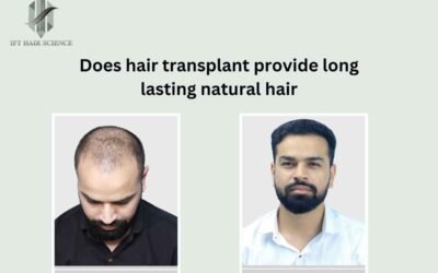 Does Hair Transplant Provide Long-Lasting Natural Hair?