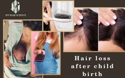 Understanding and Coping with Postpartum Hair Loss: Causes, Duration, and Coping Strategies for New Mothers