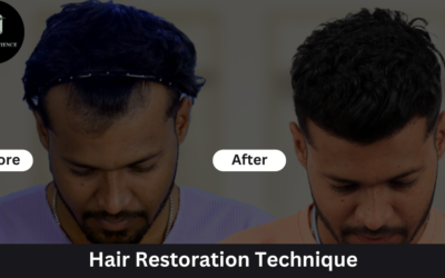 How To Know About The Most Appropriate Technique For Hair Restoration?