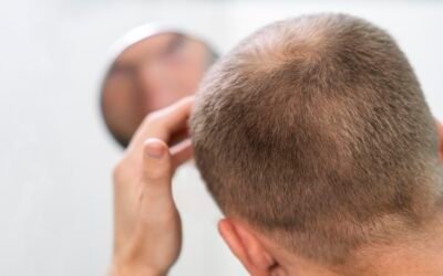 Robotic Hair Transplants: The Future of Hair Restoration