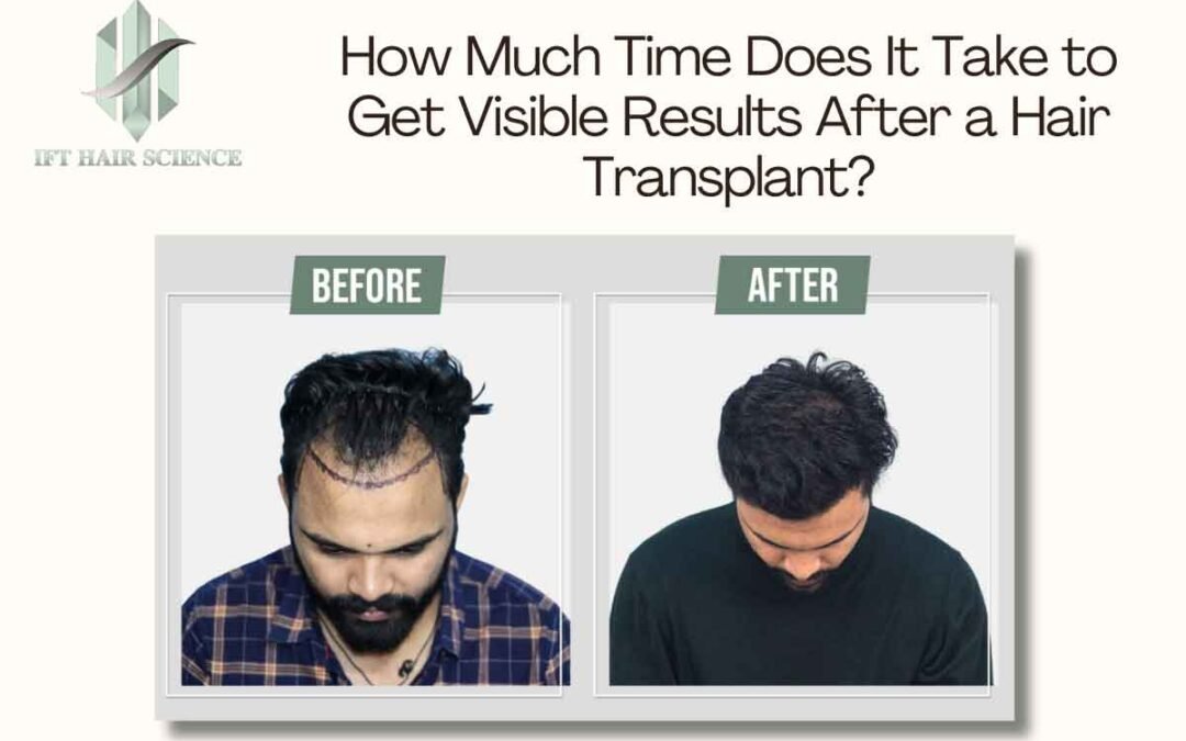 How Much Time Does It Take to Get Visible Results After a Hair Transplant?