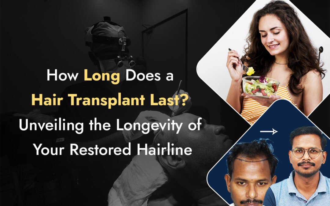 How Long Does a Hair Transplant Last?