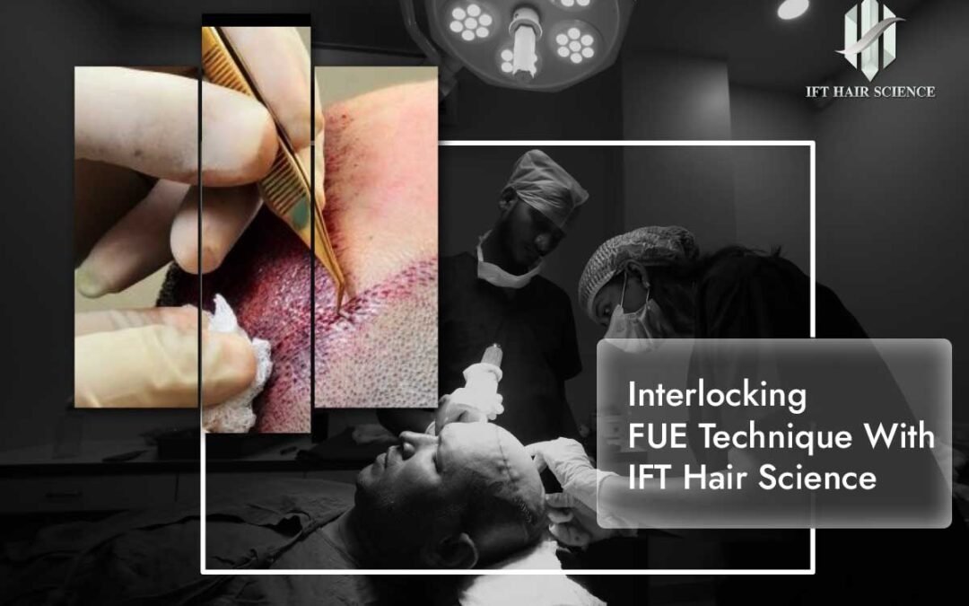 Interlocking FUE Technique With IFT Hair Science
