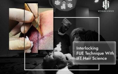 Interlocking FUE Technique With IFT Hair Science