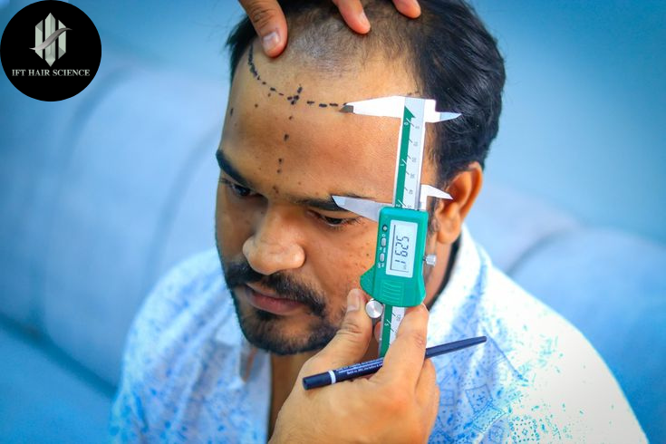 Which is the Best Hair Transplant Technique? – FUE vs DHI vs FUT
