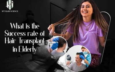 What Is The Success Rate Of Hair Transplant In Elderly
