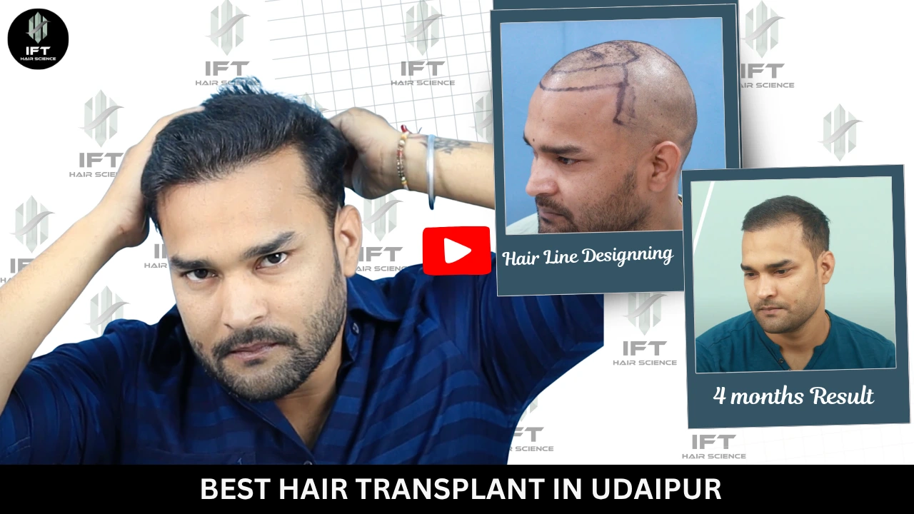 Best Hair Transplant in Udaipur