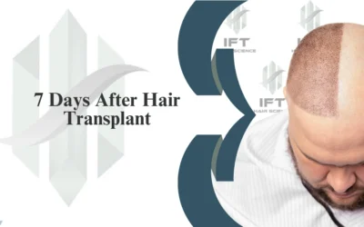 7 Days After Hair Transplant: What to Expect, Do’s & Don’ts