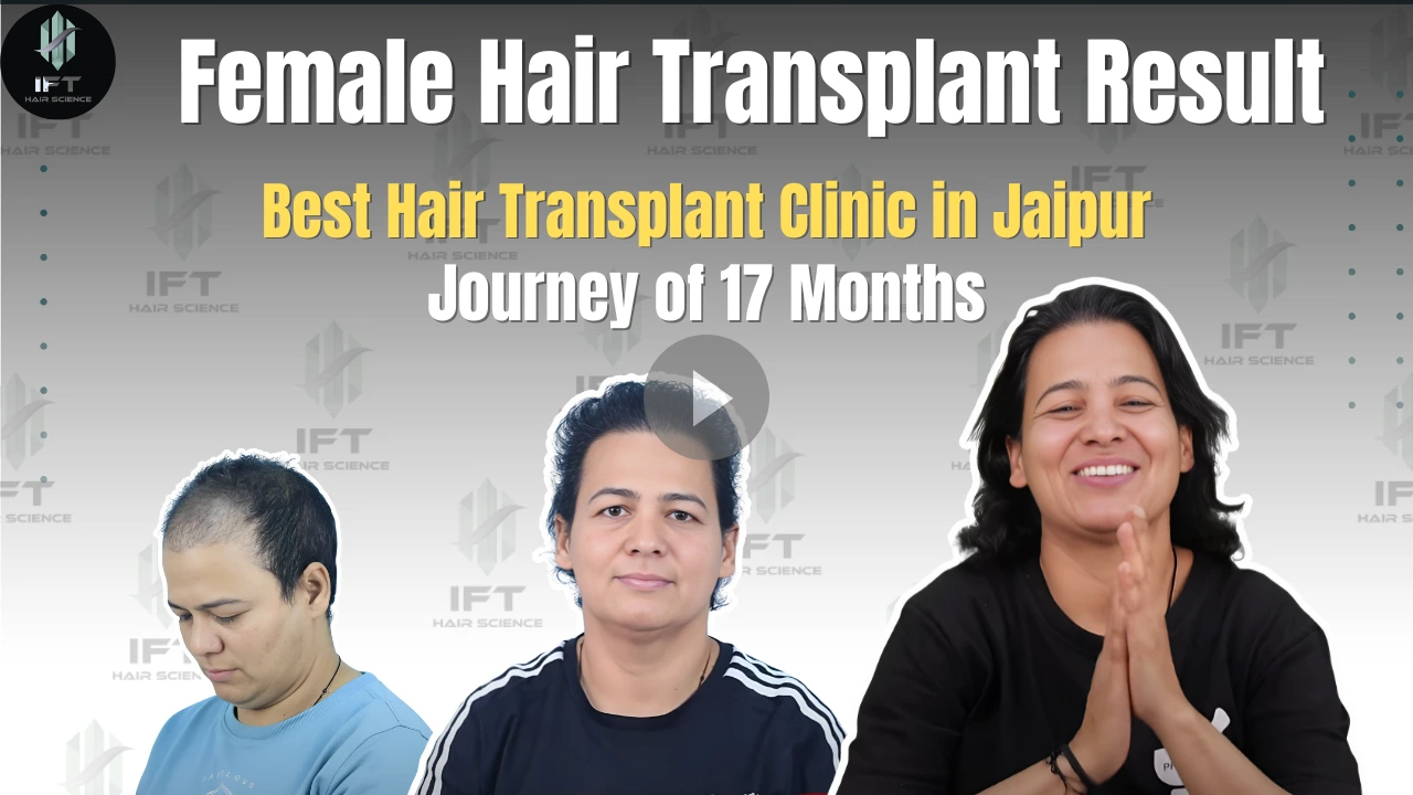 Female Hair Transplant Result Best Hair Transplant Clinic in Jaipur - IFT Hair Science